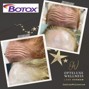 Reduce Acne Scarring Tighten The Skin Build Collagen Leaves A Glowing Appearance 2 - The Real Social Company